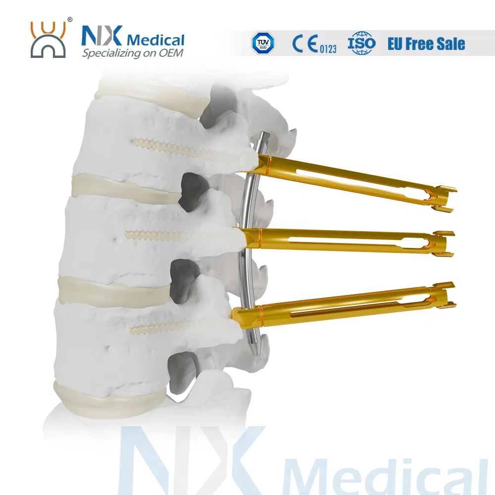 Nx Medical Advanced Sf-IV Mis Cannulated Bone Cement Spinal Pedicle Screw 5.5mm