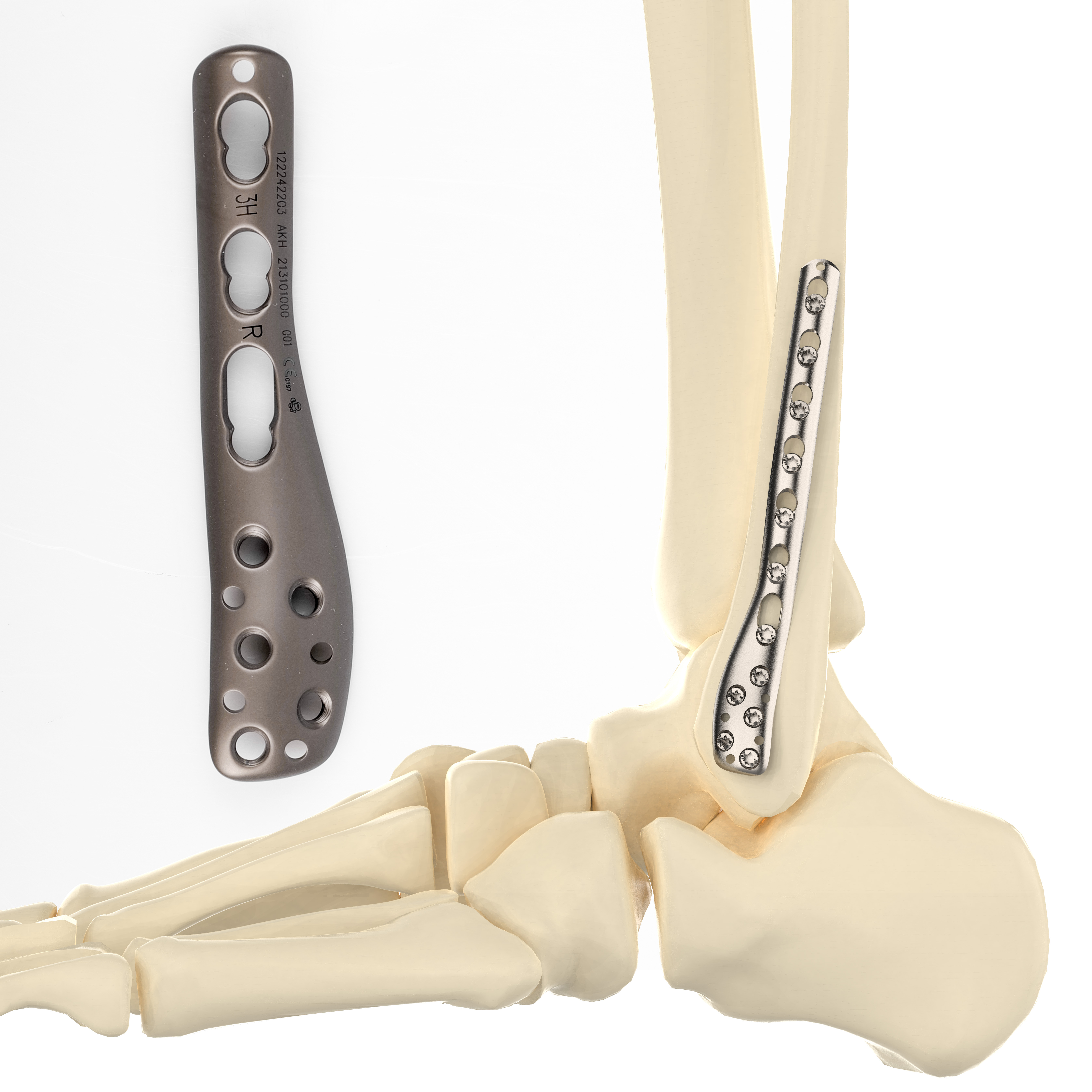 CANWELL Distal Fibula Titanium Locking Plate Fibula Plate 01 Orthopedic Trauma Implant Bone Fracture Class III 5+ Year Warranty