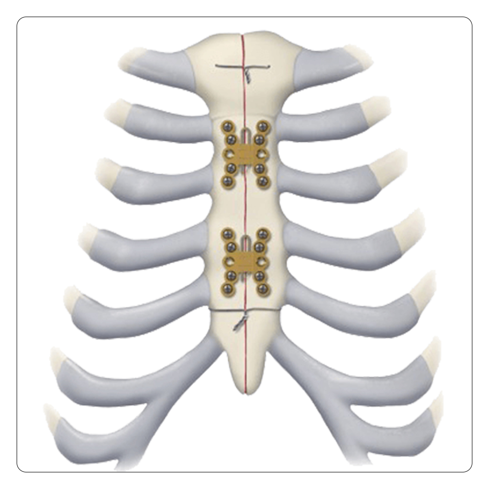 Sternal Fixation