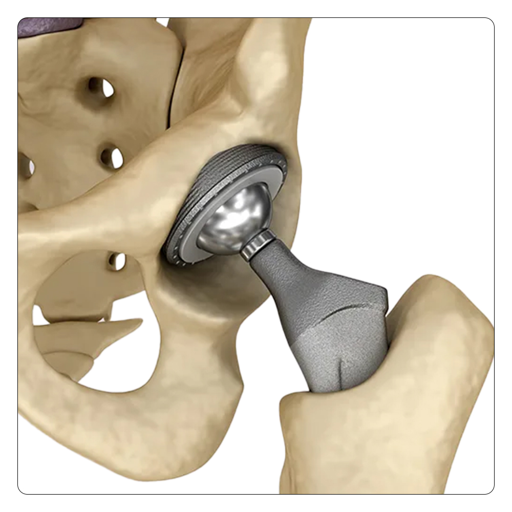 Joint System