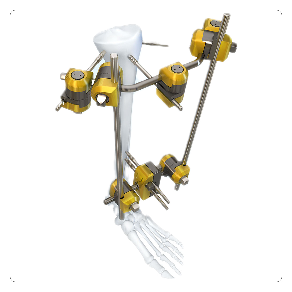 External Fixtion