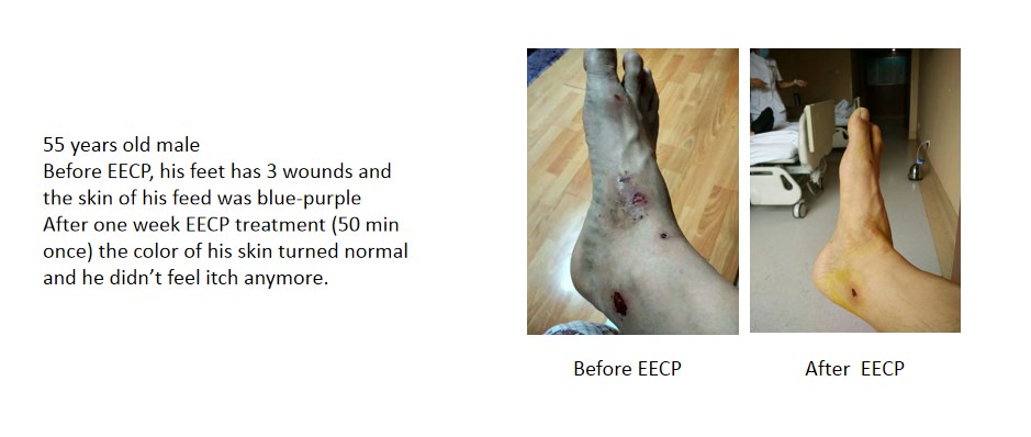 EECP Monitoring
