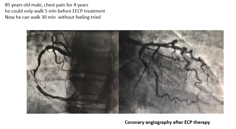 EECP Treatment Detail