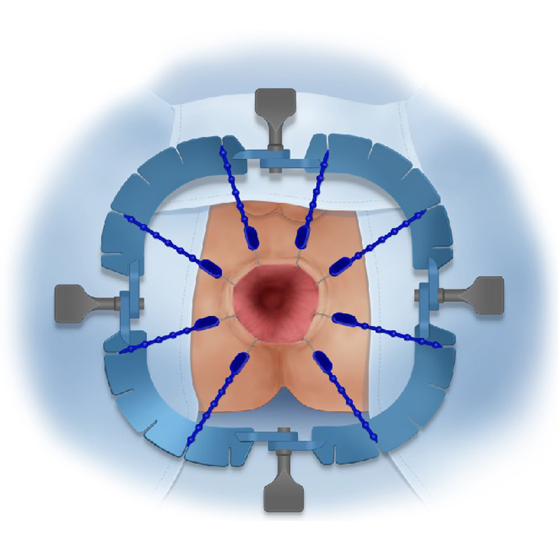 Medical Surgery Retractor System