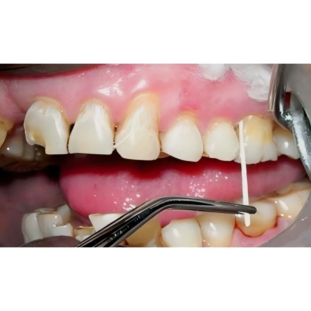 Dental Disposable Absorbent Paper Points with Grade a Quality (YQD3-4)