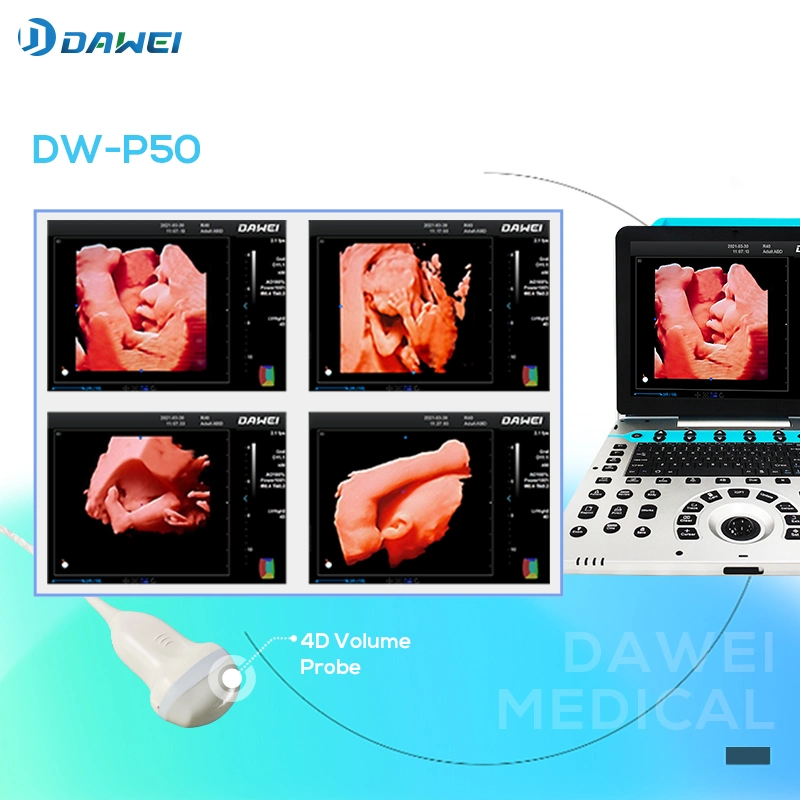 Dw-P50 Portable Ultrasound Empowers Precision Diagnostic Imaging for Gynaecology Obstetrics