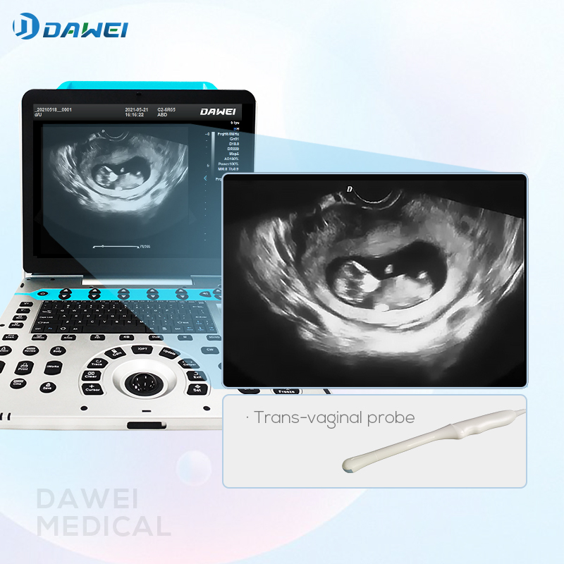 Dw-P50 Portable Ultrasound Empowers Precision Diagnostic Imaging for Gynaecology Obstetrics
