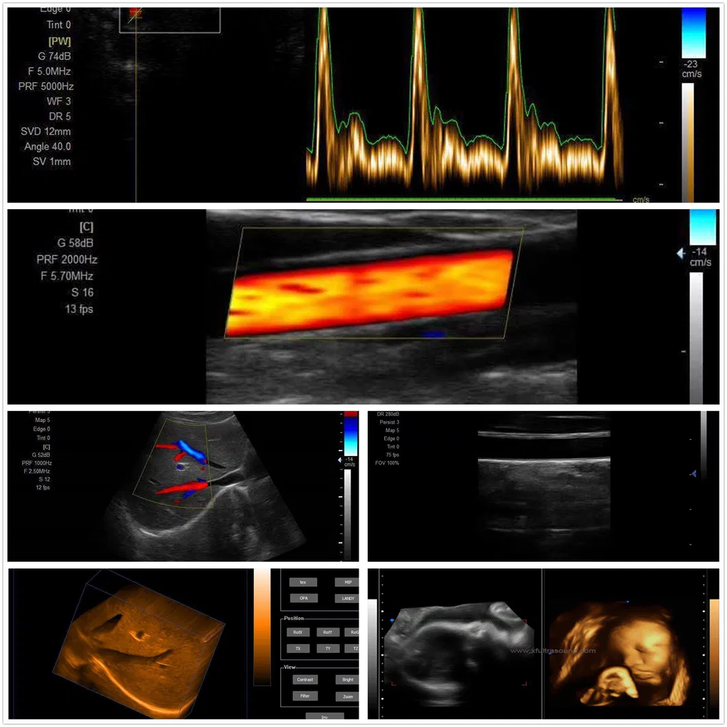 Trolley Ultrasound Diagnostic System
