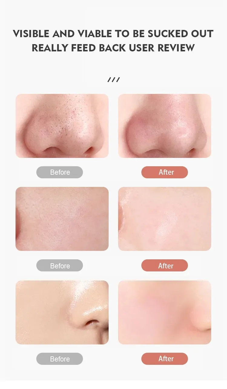 Vacuum Blackhead Remover Detail 8