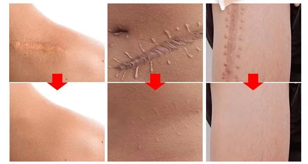 Scar Revision Patch Application 5
