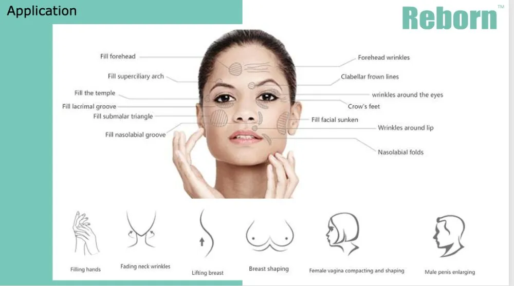 Smile Lines Removal