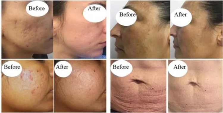 T-Ixel Radio Frequency Microneedling Fractional RF Machine for Scar Remover