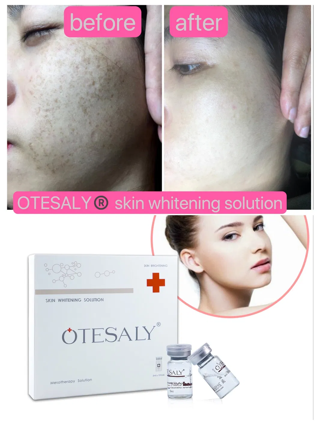 Otesaly Pdrn Solution Injectable Facial Care Skin Whitening Salmon DNA Serum Pdrn Injecction Placentex