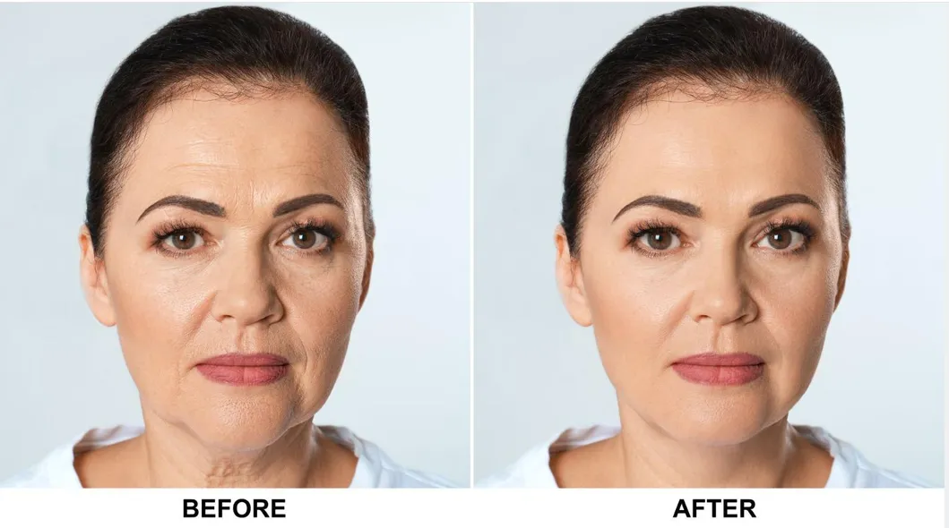 Profhilo Results