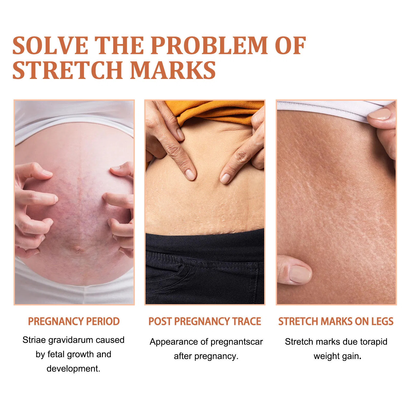 Shea Butter Scar Removal Lotion for Body Skin Stretch Marks Fades and Smooths Stretch Mark Cream for Pregnancy Care