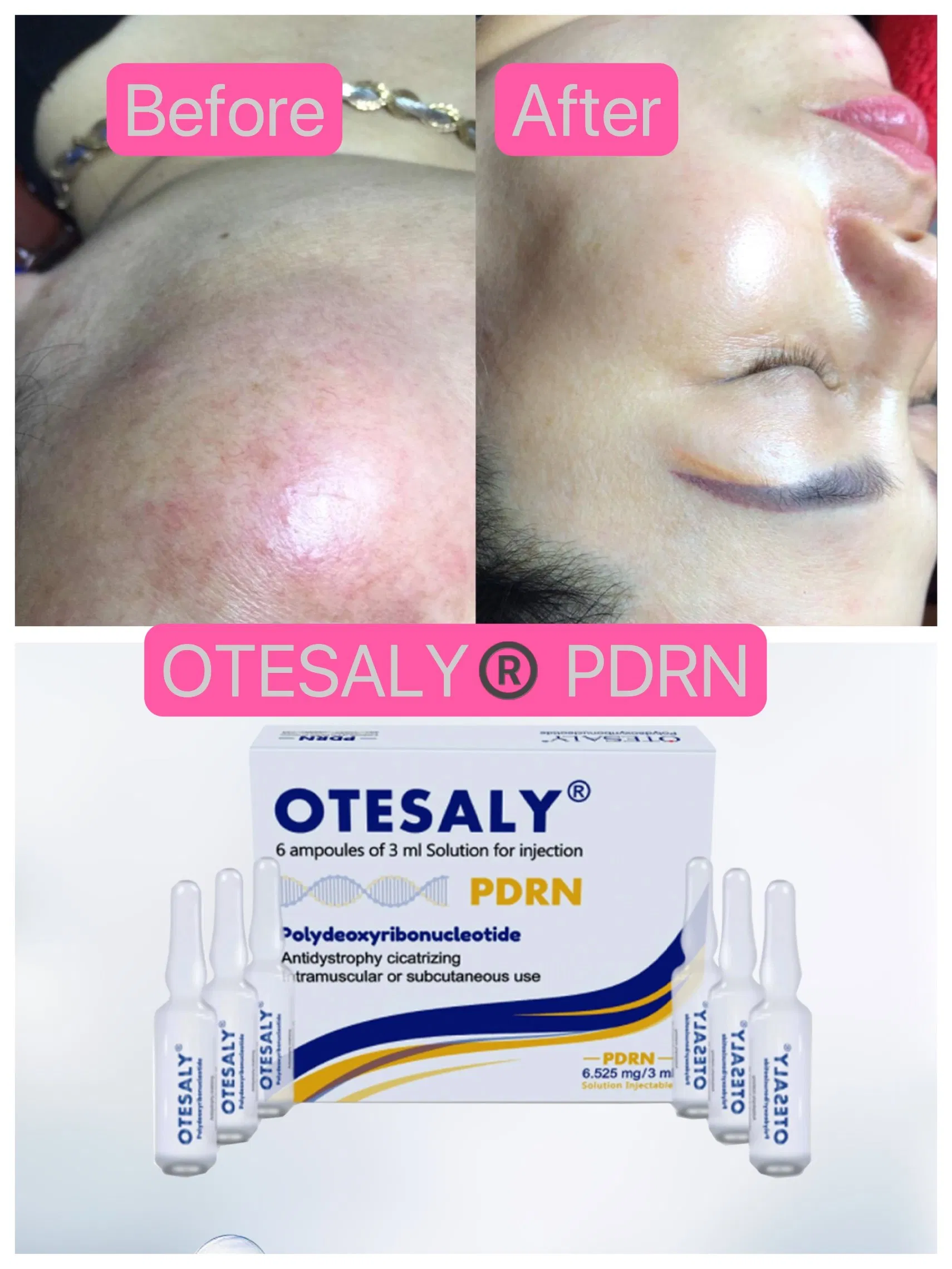 Otesaly Pdrn Solution Injectable Facial Care Skin Whitening Salmon DNA Serum Pdrn Injecction Placentex