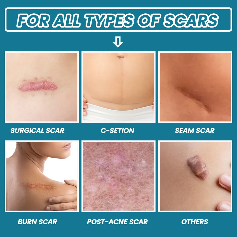 Scar Treatment Result