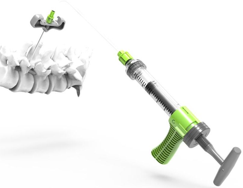 Orthopedic Instruments Cement Spiral Injections Device