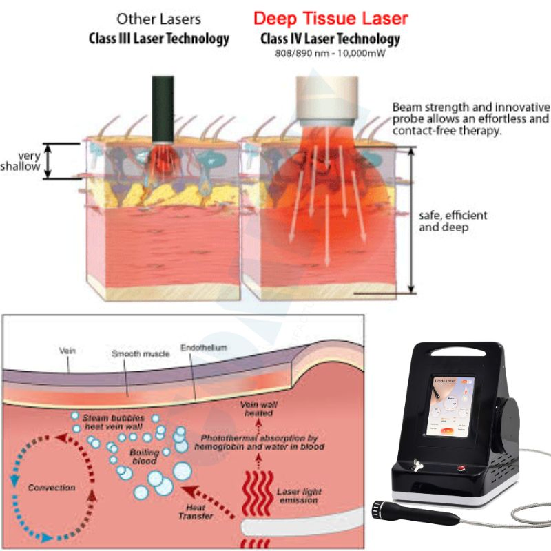 Sistema a Laser Controlado por Temperatura Inteligente 1064nm 30W para Recuperação Clínica Segura em Fisioterapia