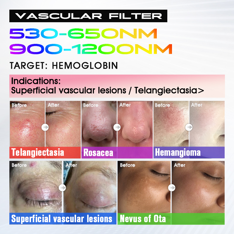 Vascular Filter skin result