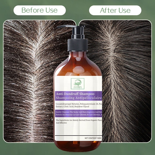 Private Label Dandruff Removal Anti Dandruff Shampoo Dryness and Itch Relief for Dry and Itchy Scalp Dry Scalp Treatment