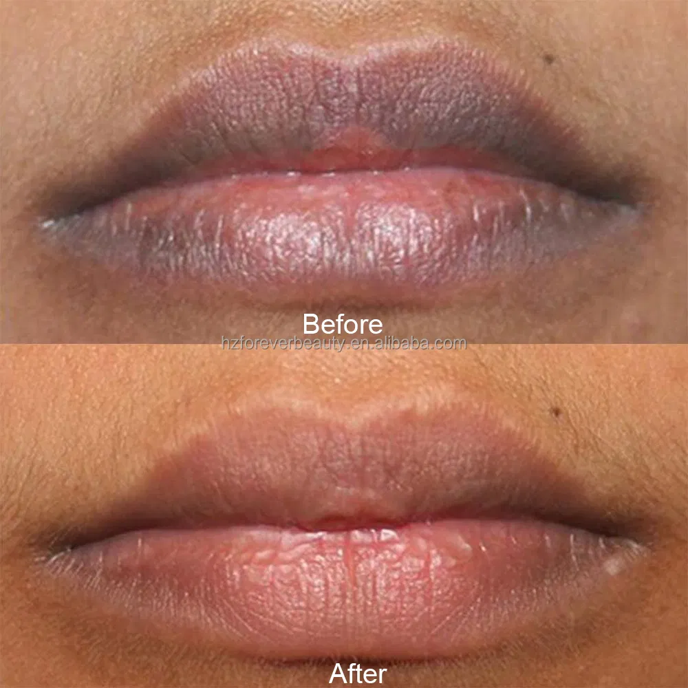 Custom Lip Whitening Treatment Peptide Collagen Lips Treatment Private Label for Dry Crackle Dark Lips