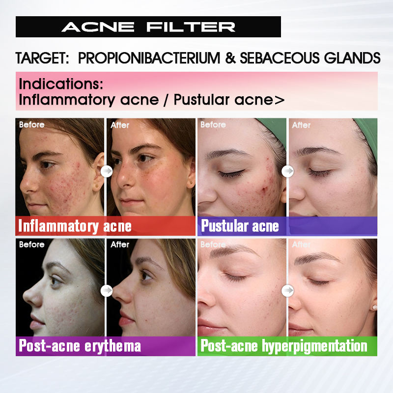 Acne Filter skin result