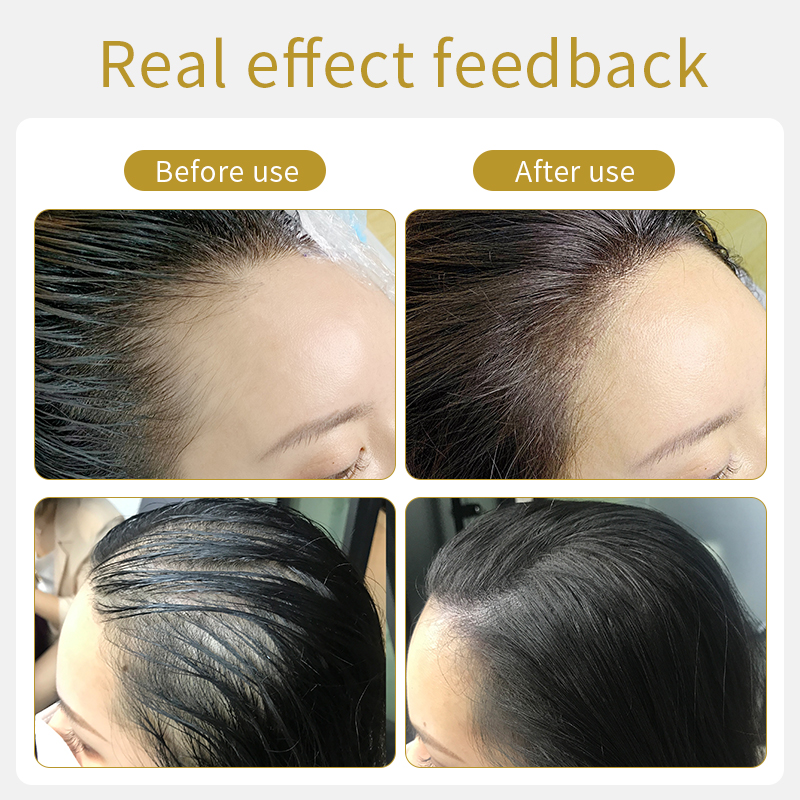 Anti Hair Loss Treatment for Hair Loss Prevention Scalp Ampoule Hair Serum with Stem Cell Essence