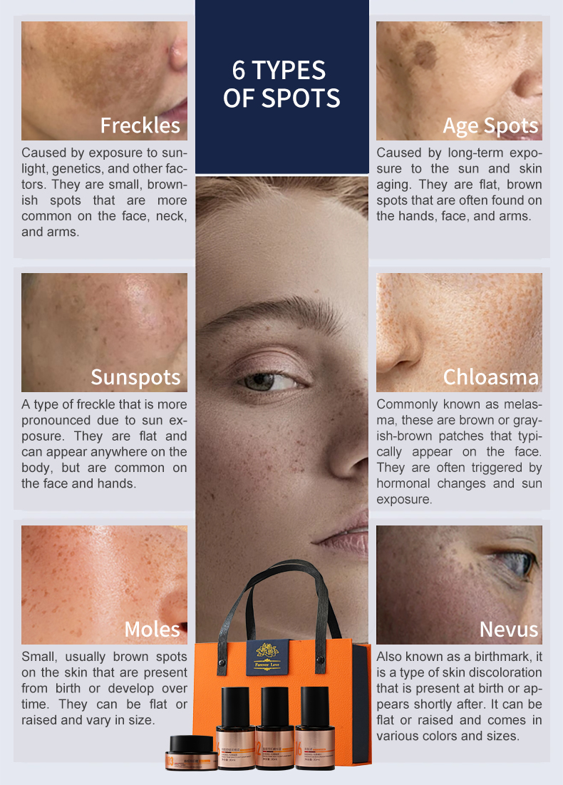 Hyperpigmentation Caused by Heavy Metals in Cosmetics 4 In1 Skin Blemish Melasma for Face Pigmentation Peel Remove Treatment Set