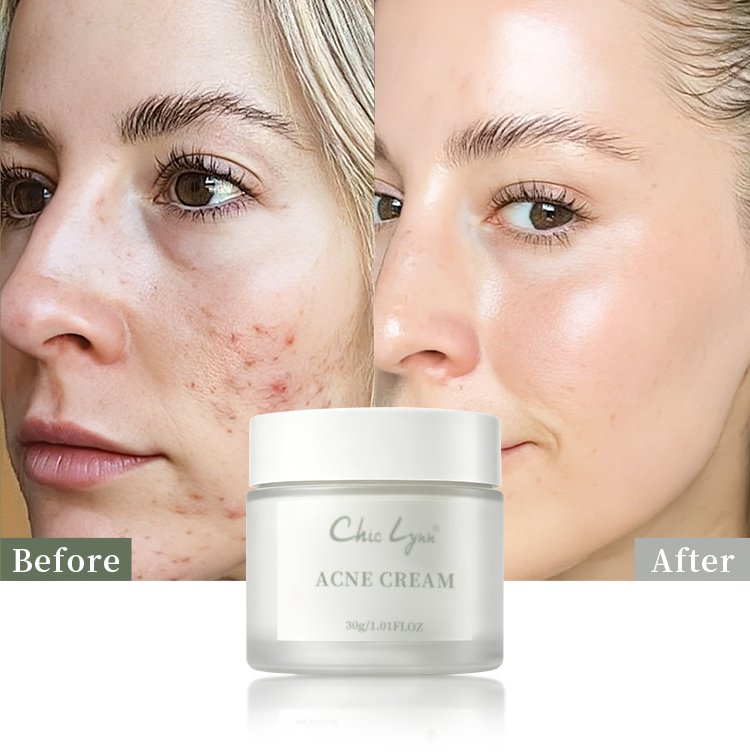 Salicylic Acid Acne Removing Face Cream for Students Acne Removing and Moisturizing Face Cream