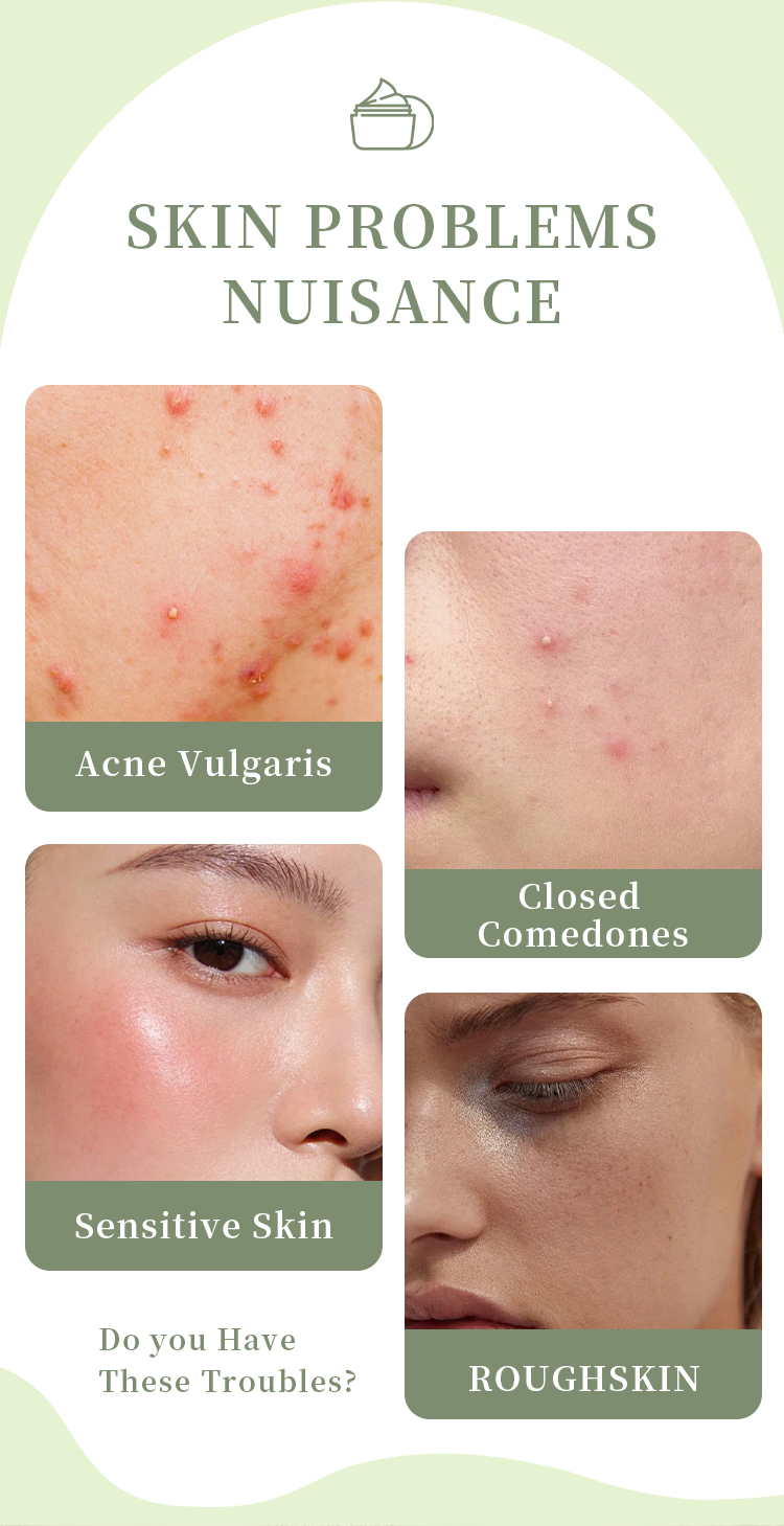 Salicylic Acid Acne Removing Face Cream for Students Acne Removing and Moisturizing Face Cream