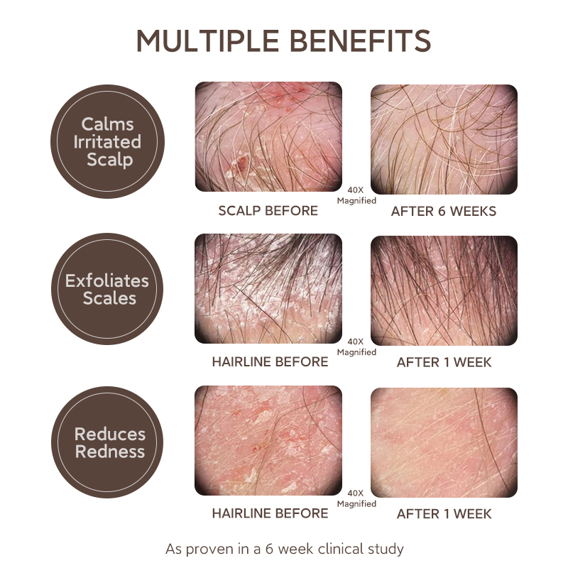 In Stock Scalp Care Product Scalp Exfoliator Purifying Nourishing Anti Dandruff Detox Peppermint Hair Scalp Purifying Solution