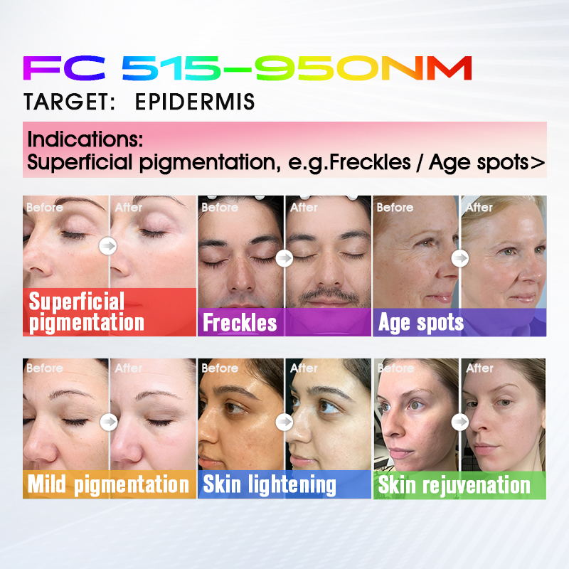 Durable Medical Level BBL Plus Anti Aging Machine Neck Facial Whole Body Anti Wrinkle Firming Device