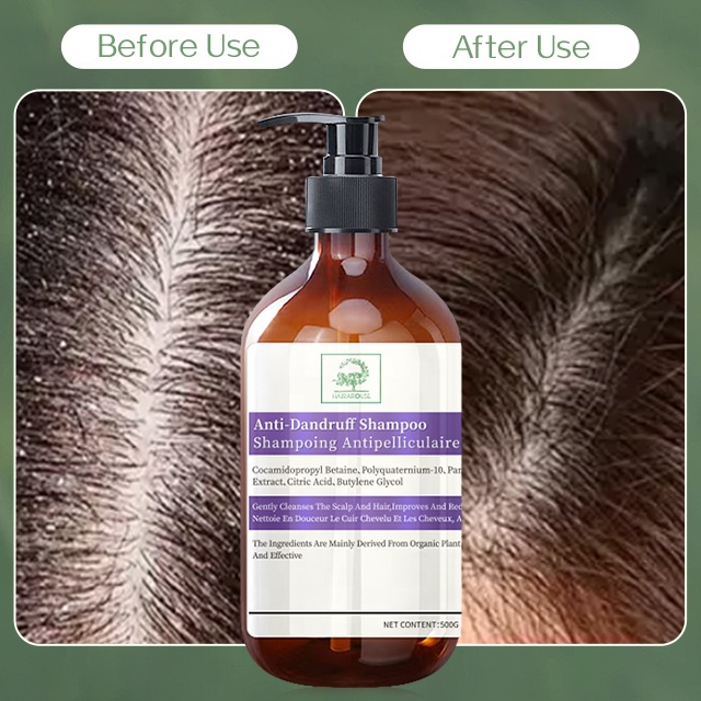 Private Label Dandruff Removal Anti Dandruff Shampoo Dryness and Itch Relief for Dry and Itchy Scalp Dry Scalp Treatment