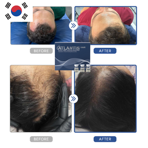 Atlantis Scalp Care Serum Liquid PDRN Exosome Hair Strengthening Growth Support Hydration Soothing Treatment Scalp