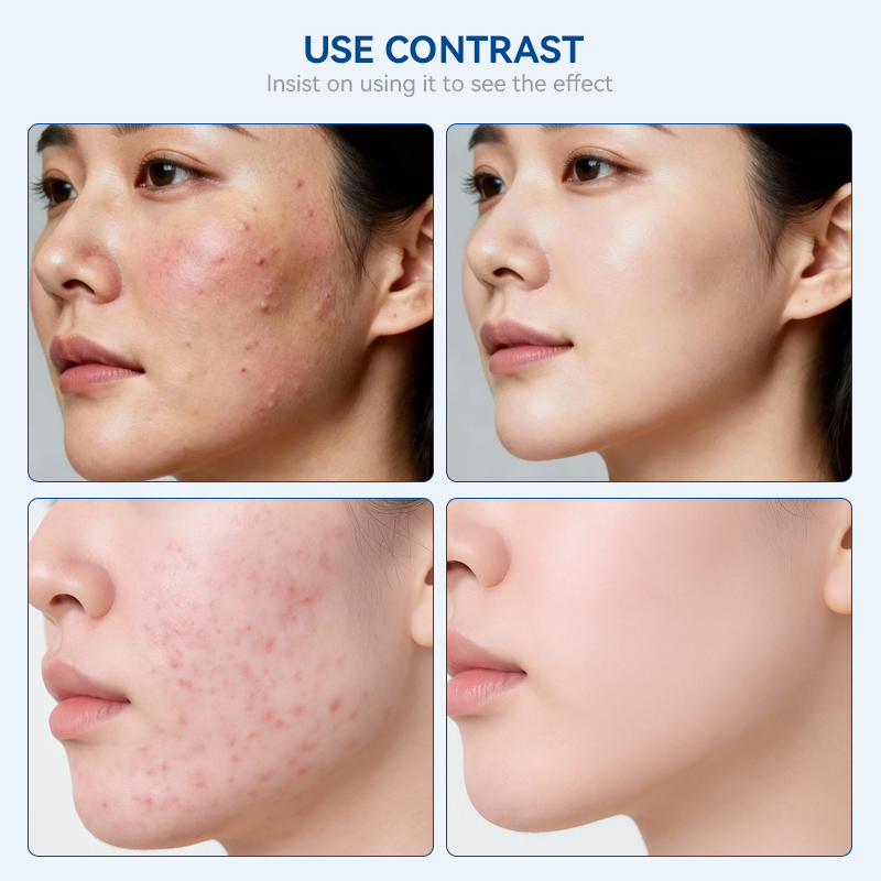 Fast Effective Repair Pimple Scar Anti Spots Removal Gel Smooth Salicylic Acid Skin Shrink Pores Acne Face Cream