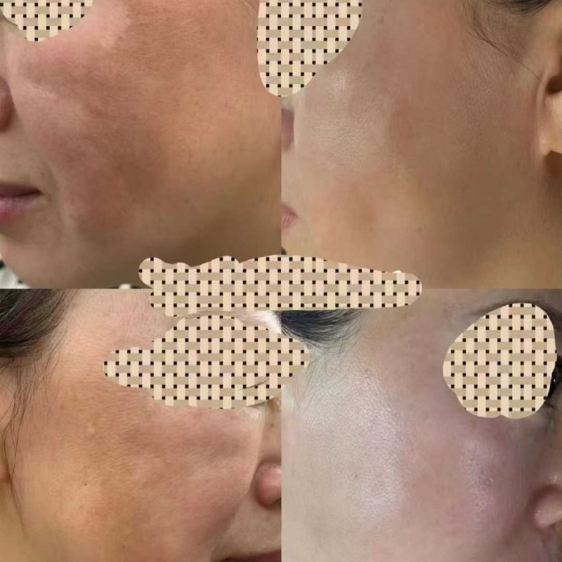 OEM Professional Stubborn Dermal Spot Fading Kit Deep Melasma Hyperpigmentation Peel Correction Remove Even Skin Tone Facial Set