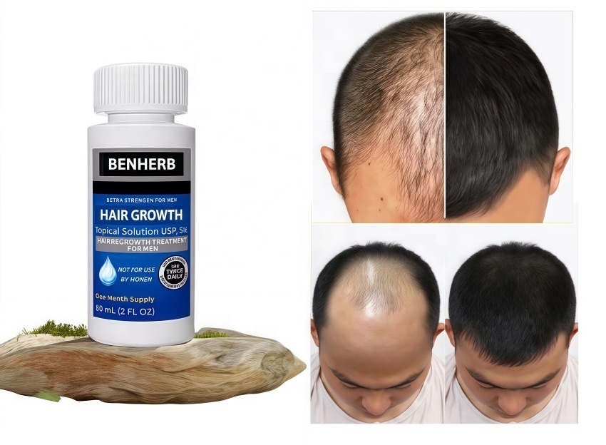 Private Label 5% Men's and Women's Hair Regeneration Essence - Clinical Strength Biotin Hair Loss Treatment - Scalp Growth Oil