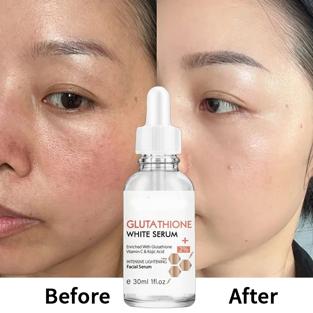 Glutathione Serum for Targeted Hyperpigmentation Care