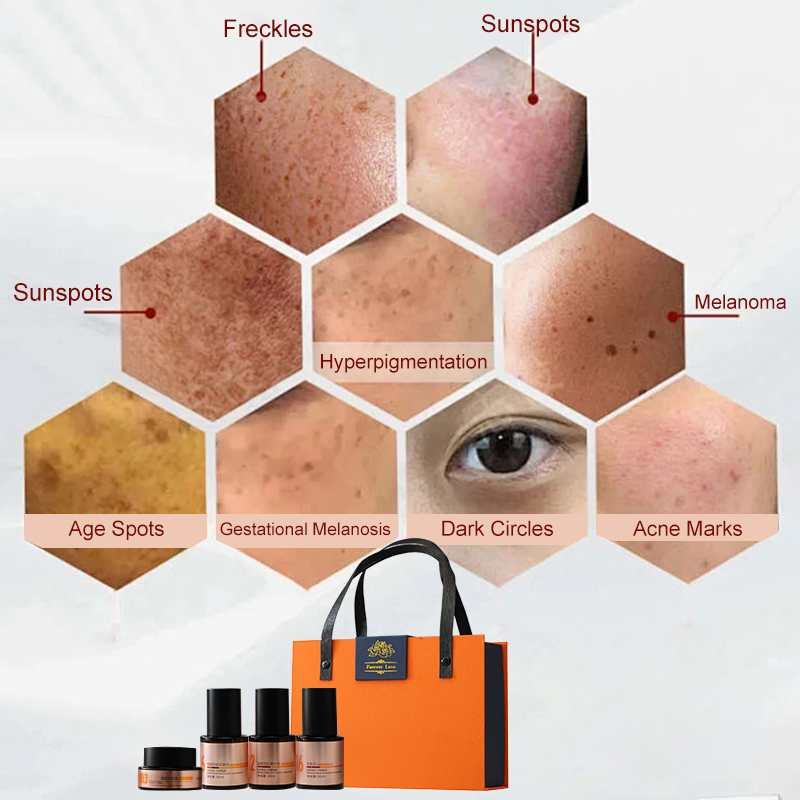 Hyperpigmentation Caused by Heavy Metals in Cosmetics 4 In1 Skin Blemish Melasma for Face Pigmentation Peel Remove Treatment Set