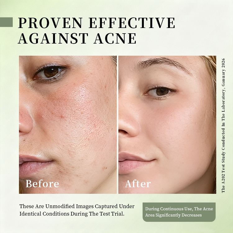 Salicylic Acid Acne Removing Face Cream for Students Acne Removing and Moisturizing Face Cream