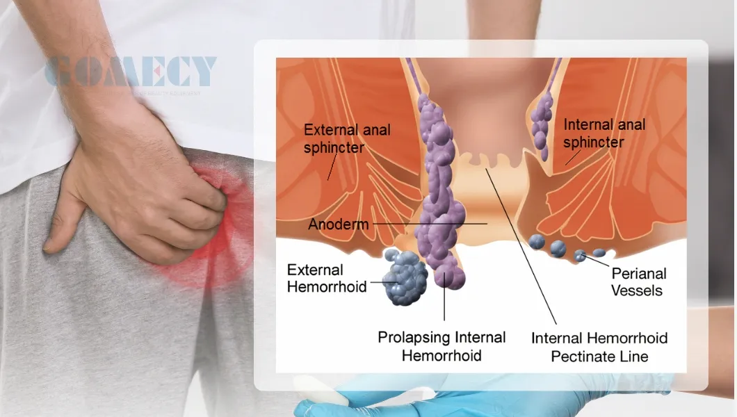Equipo de láser Evlt/ Tratamiento Evlt Tratamiento de dolor en las venas de las piernas Clase 4 Láser en venta Variceslaser Endovascular PARA Varices Disolviendo grasas