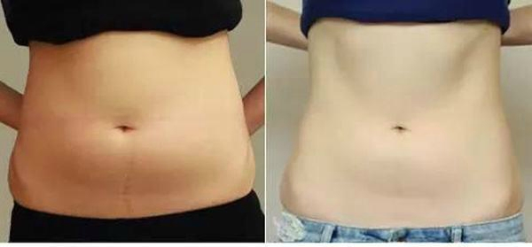 Diodo Endolaser 980 Nm 1470 Dispositivo de Lifting Facial Láser Liposucción Lipólisis