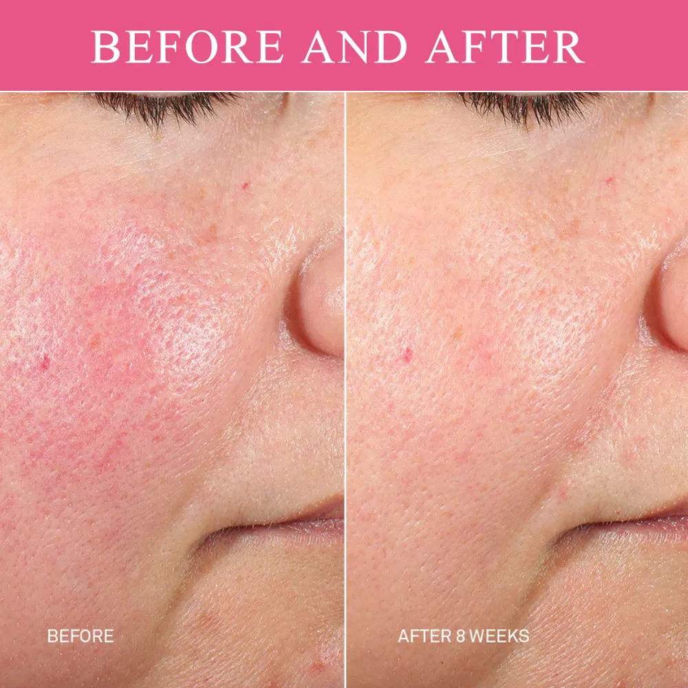 Esencia de microperlas de lujo no explosiva para mujeres, suero facial anti-envejecimiento y aclarador de rosa