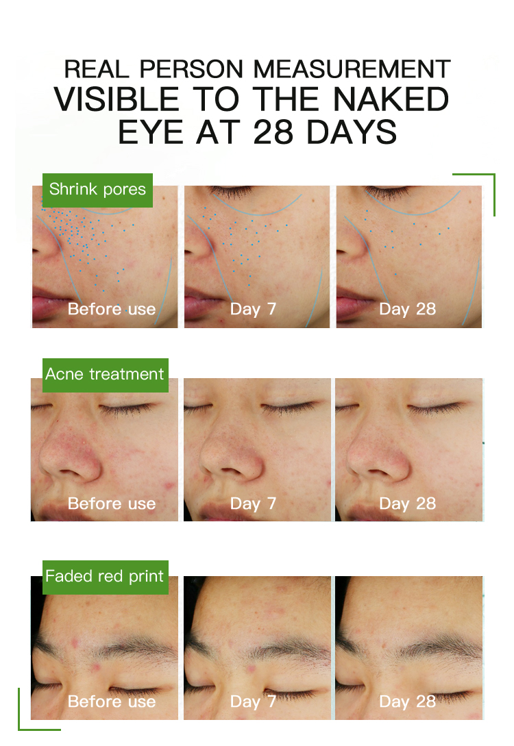 Suero Facial Exfoliante Anti Acné de Marca Privada 30ml Tratamiento Removedor Reparador de Piel Suero de Ácido Azelaico