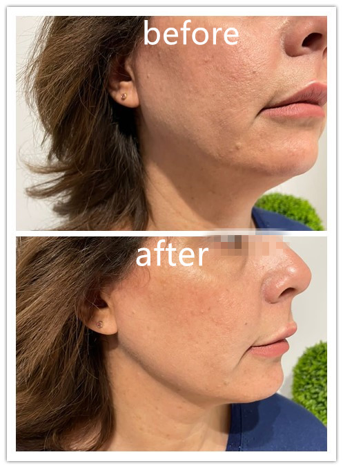 Liposucción Vaser Fiberlift 1470nm+980nm Máquina de Lifting Facial Endoláser Dispositivo Láser para Reafirmar la Piel