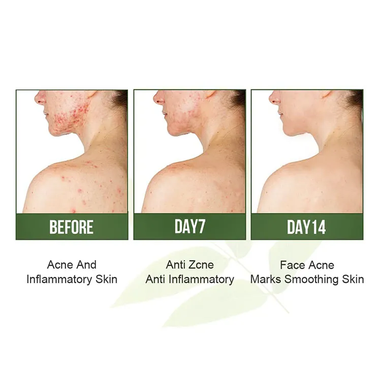 Conjunto de cuidado de la piel de crema facial de suero de aceite de árbol de té hidratante, calmante, reparador, antiacné y antienvejecimiento