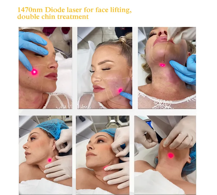 Cirugía Médica Láser 1470 Eliminación de Celulitis con Láser de Diodo Lipólisis Pérdida de Peso Esbeltez Corporal Cirugía de Liposucción