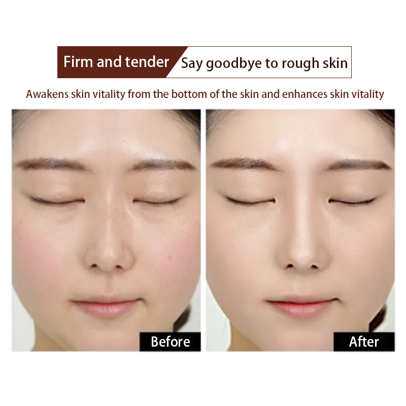 Tratamiento para el acné con ácido hialurónico, exfoliante, contracción de poros, restaurar la elasticidad de la piel, suero facial