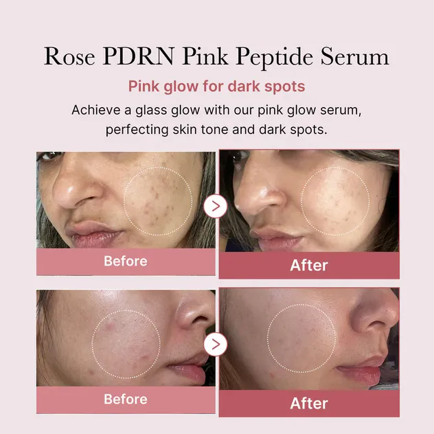 Suero de Péptido Rosa Pdrn Vegano Cuidado de la Piel Coreano Corrección de Manchas Oscuras Suero Facial